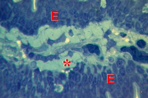 M,60y. | jejunum - amyloidosis(semithin section) M,60y. | jejunum - amyloidosis(semithin section)